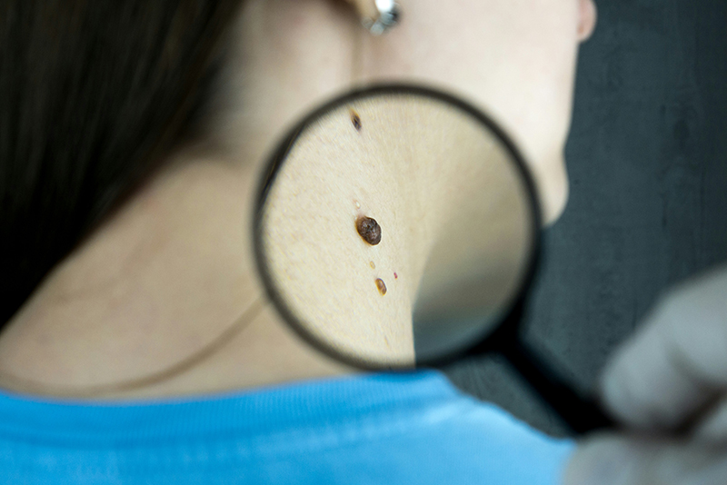 Dermatology services in Tulsa - zoom of woman's large mole